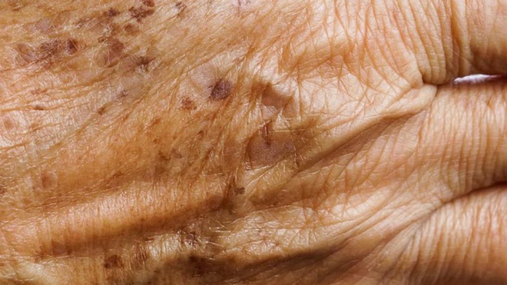 Jak pozbyć się starczych plam na twarzy i ciele?