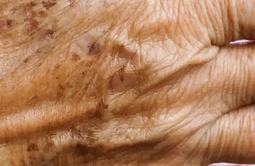 Jak pozbyć się starczych plam na twarzy i ciele?